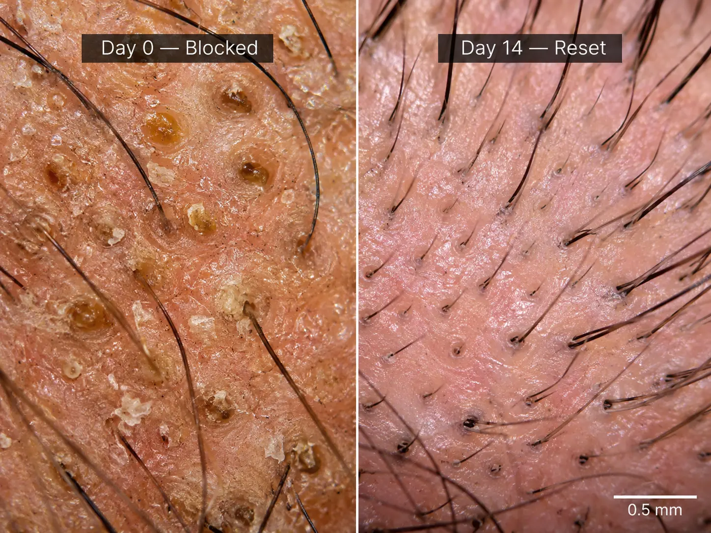 Split macro-style scalp visual comparing blocked follicles with a cleaner reset scalp
